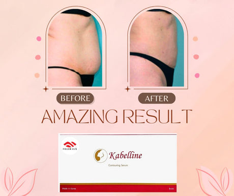 Achieve Body Contouring with Kabelline Contouring Serum Lipolytic - Filler Lux™