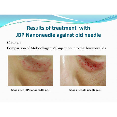 JBP Nanoneedle - Filler Lux™ - Needles - Japan Bio Products Co., Ltd.