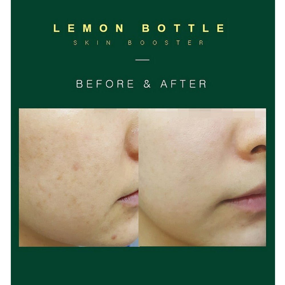 Lemon Bottle Skin Booster - Filler Lux™ - Mesotherapy - Filler Lux USA