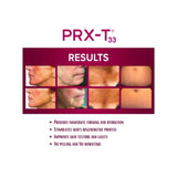 PRX-T33 - Filler Lux™ - Peeling - WiQOmed